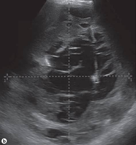 Figure 1 From Malignant Cause Of Ventriculoperitoneal Shunt ‘pseudocyst A Case Report