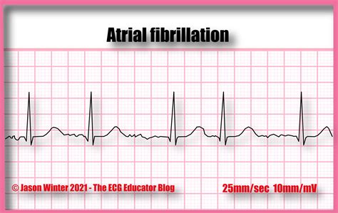 Atrial Fibrillation Ecg