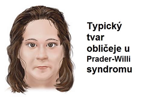 Prader Willi Syndrom Pws Příznaky Projevy Symptomy Příznaky A