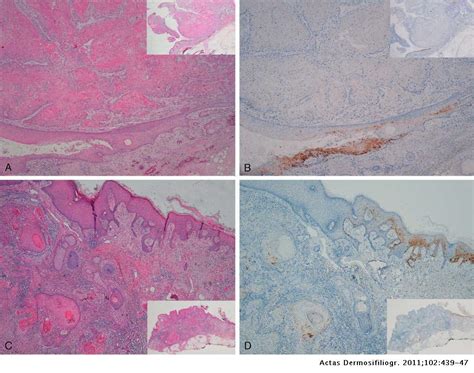 Immunohistochemical Staining Of P16 In Squamous Cell Carcinomas Of The