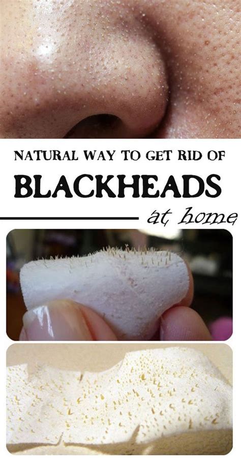 Permanently Remove Blackheads Natural Mask Get Rid Of Blackheads