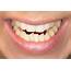 Crooked Teeth Causes Symptoms And Treatment