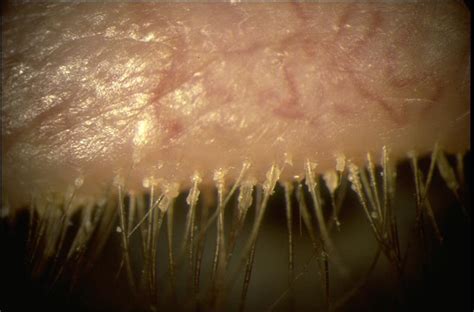 Meibomian Gland Dysfunction American Academy Of Ophthalmology