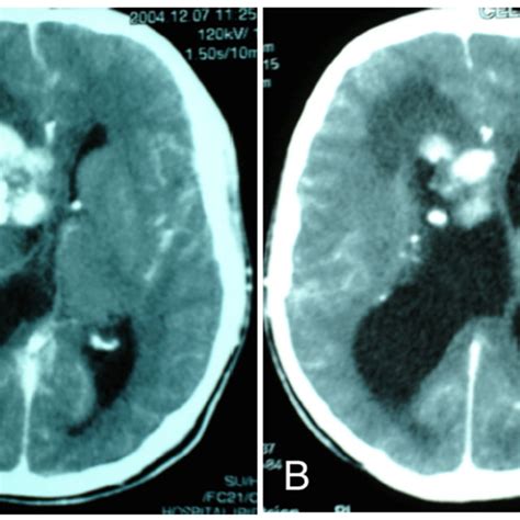 Pdf Obsessive Compulsive Disorder In A Patient With Tuberous