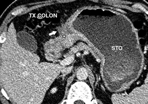 Gastric Cancer Patterns Of Disease Spread Via The Perigastric