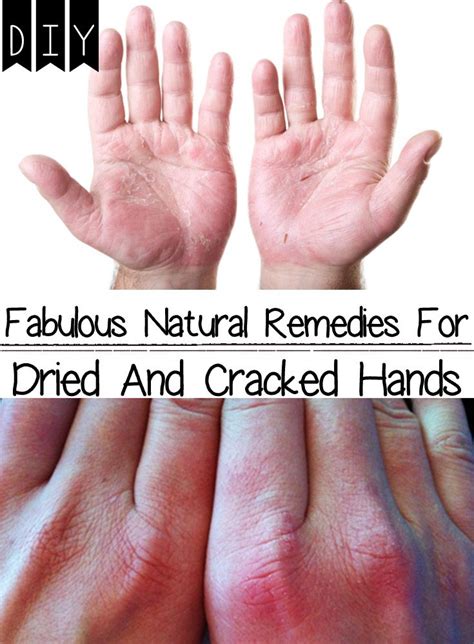 Natural Remedies For Dried And Cracked Hands Dry Hands Remedy