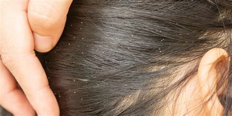 7 Common Signs Of Lice Head Lice Symptoms And Treatment