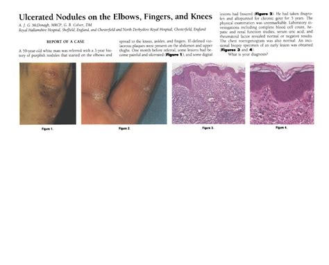Jama Network Jama Dermatology Ulcerated Nodules On The Elbows