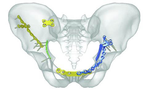 Acumed Launches Pelvic Plating System Opnews