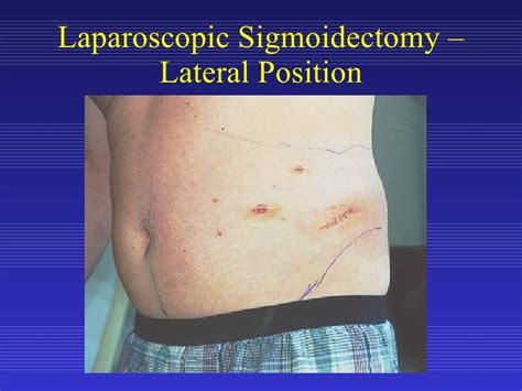 Laparoscopic Sigmoid Colon Resection For Diverticular Disease