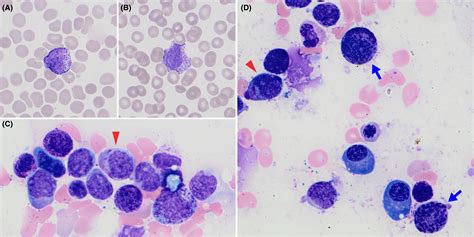 Acute Promyelocytic Leukemia Presenting With Atypical Basophils