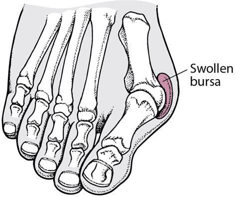 Table Hallux Valgus With A Bunion Msd Manual Consumer Version