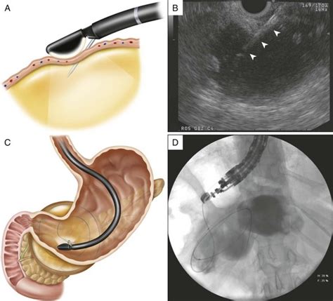 Endoscopic Ultrasound Guided Transmural Drainage Of Postoperative My