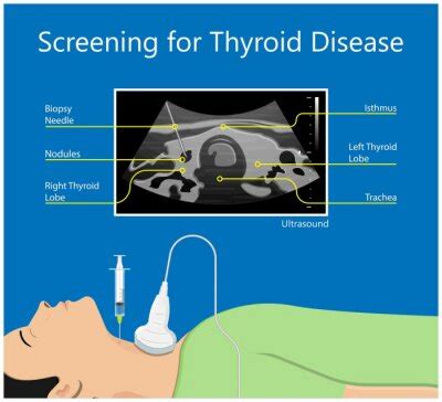 Thyroid Fine Needle Aspiration Biopsy Procedure Sample Tissue Posters