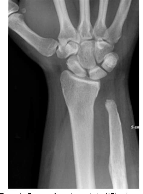 Figure From Distal Radioulnar Joint Arthroplasty With A Scheker Prosthesis Semantic Scholar