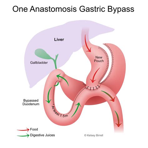 One Anastomosis Gastric Bypass Mini Toowoomba Bariatric Surgery South East Qld