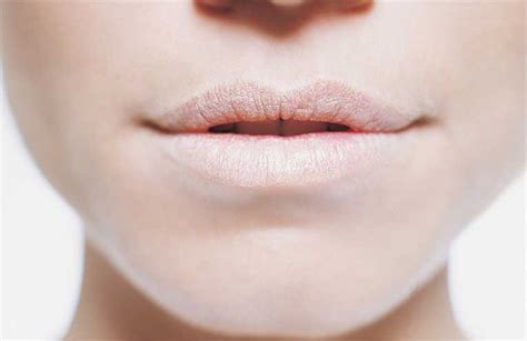 Dont Ignore These Dry Lips And Mouth Symptoms