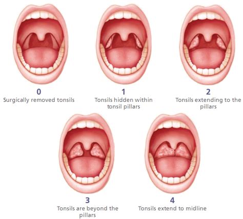 Chronic Tonsillitis In Kochi Id 8326634648