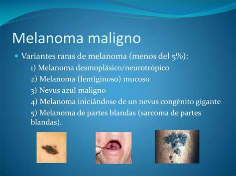 Ppt Melanoma Maligno Powerpoint Presentation Free Download Id2058861