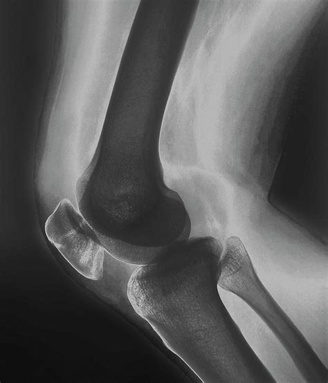 Broken Knee By Zephyr Science Photo Library