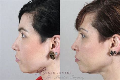 Rhinoplasty Before And After Pictures Case 171 Paramus Nj Parker