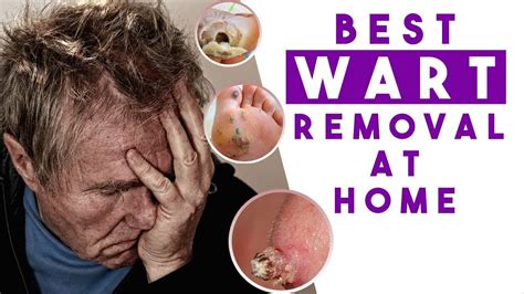 Treat Warts Fast Powerful Wart Removal Treatment At Home Youtube