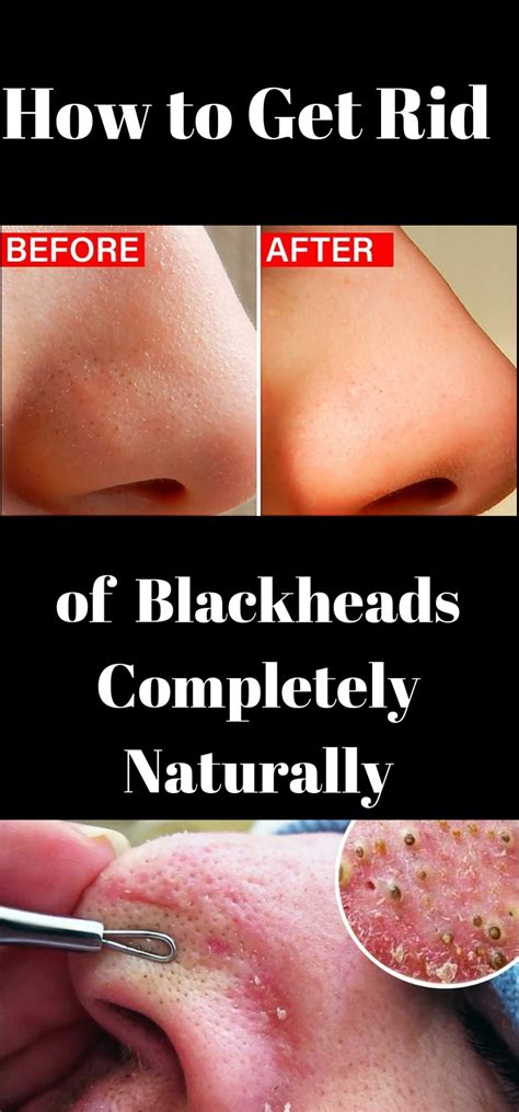 Daily Health Advisor How To Get Rid Of Blackheads Completely Naturally