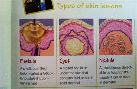 Types Of Lesions Pustule Cyst Nodule Nclex Nclex Rn Nursing Exam