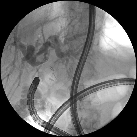 Single Balloonassisted Ercp With Electrohydraulic Lithotripsy For The