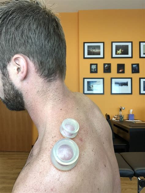 Cupping Therapy Common Areas To Find Peripheral Nerve Entrapment — Evolve Performance
