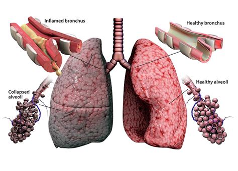 Chronic Obstructive Pulmonary Disease Photograph By Gunilla Elam