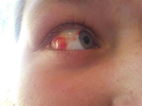 Red Spot In Eye On Friend What Is It She Almost Cant See Wtf