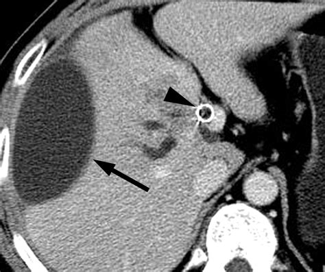 Hepatic Capsular And Subcapsular Pathologic Conditions Demonstration