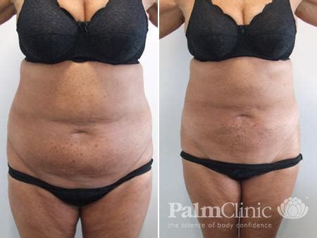 Stomach And Abdomen Liposuction Before And After Photos Palm Clinic