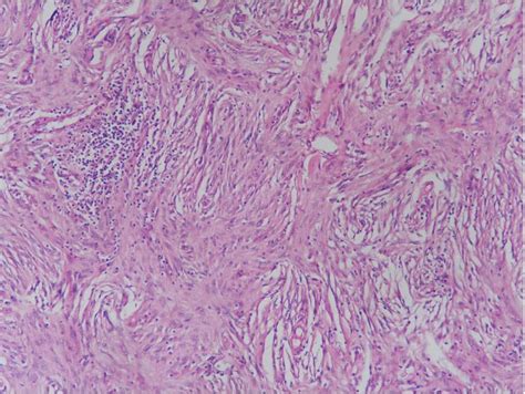Fibrous Histiocytoma Of Bone Histopathologyguru