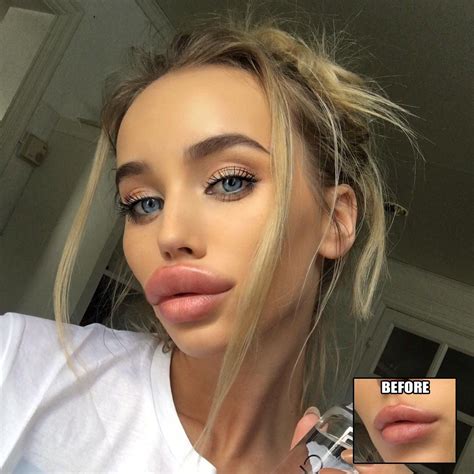 Wax Lips Lip Fillers Bimbo Other Woman Gorgeous Women Enhancement