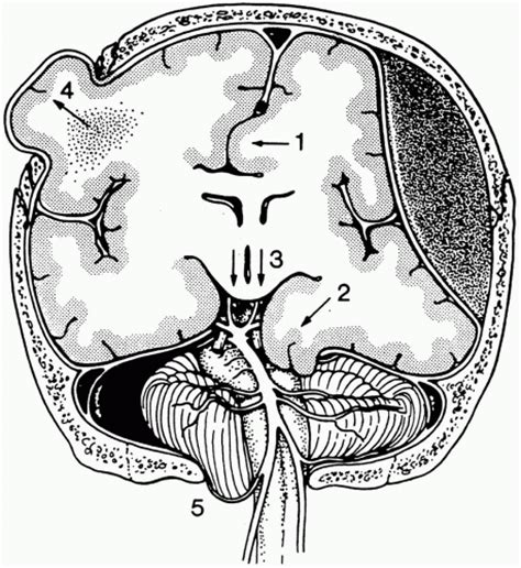 Brain Herniation Radiology Key