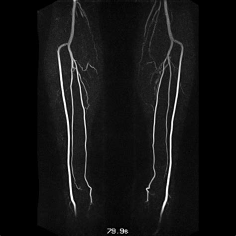 Visualization Of Lower Leg Vessels Collaterals In A Patient With