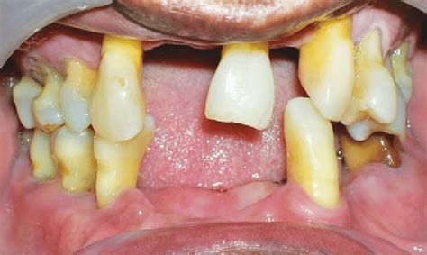 Preoperative Intraoral View Download Scientific Diagram