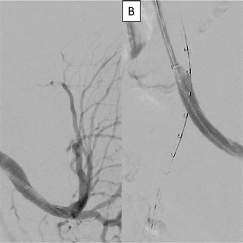 Intraoperative Digital Angiography Of The Left Internal Iliac Artery