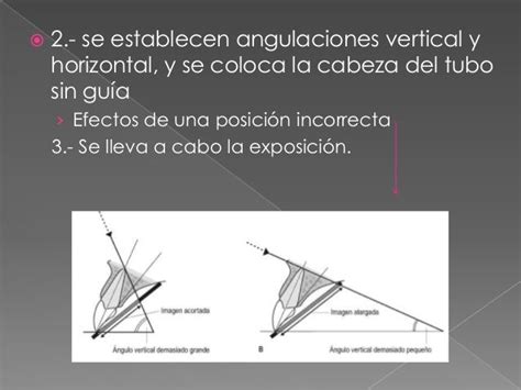 Tecnica De Bisectriz