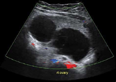 Doppler Ultrasound Showing Multiple Cysts On The Right Rt Ovary