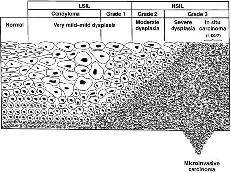 Cervical Intraepithelial Neoplasia Grade