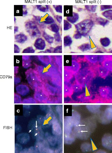 Api2 Malt1 Fusion Positive Malt Lymphoma Of The Lung Large Lymphoid