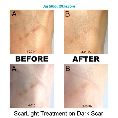 How I Faded A Dark Scar With Scarlight Dark Scar Treatment Just About