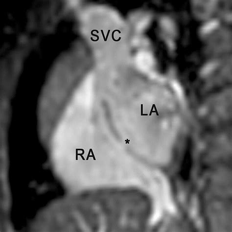 Patient 2 Cardiac Mri Without Contrast Sagittal View Of 3d Bssfp