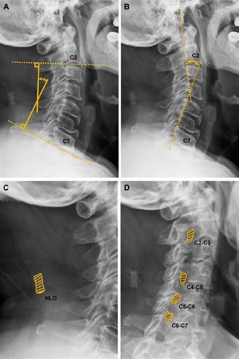 The Measurement Of X Ray Finding Of Cervical Spine A The Modified