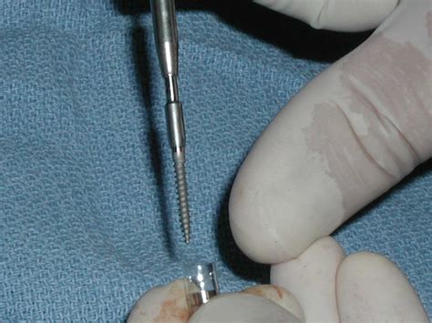 Mini Dental Implants Dr Caputo Palm Harbor Dentist