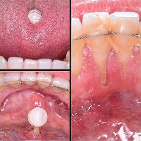 Oral Health Risks Of Tongue Piercings News Dentagama