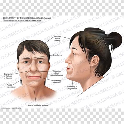 Acromegaly Face Gigantism Symptom Nose Face Transparent Background Png